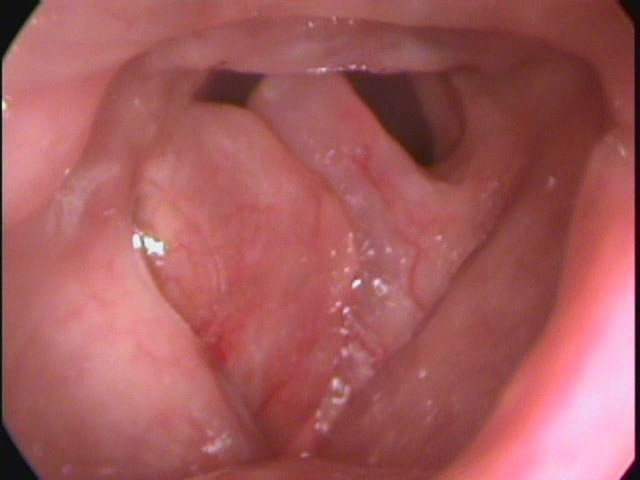 Papillomavirus nas cordas vocais, Schistosomiasis cercariae Papillomavirus nas cordas vocais