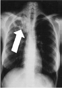 Resultado de imagem para radiografia de torax tuberculose pulmonar
