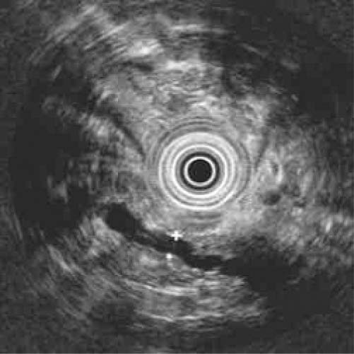 Imagens oriundas de tomografia microscópica mostrando rupturas nos