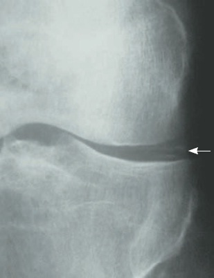 artrite microcristalina