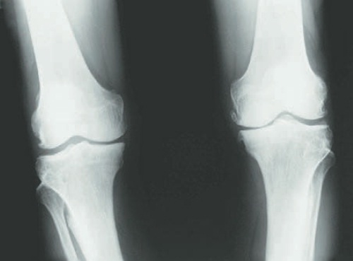 Artrita erozivă a genunchiului