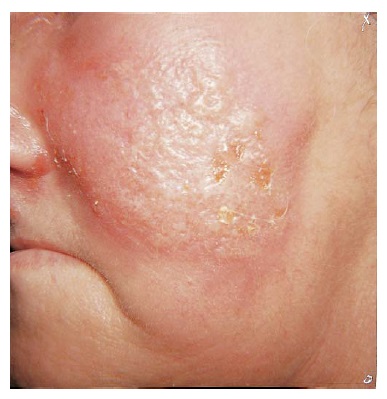 facial dermatitis #9